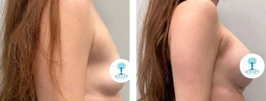 breast augmentation 1-2