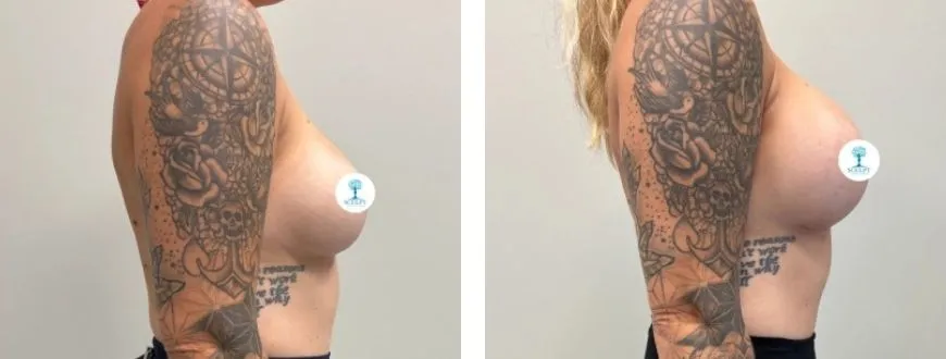 breast lift 2